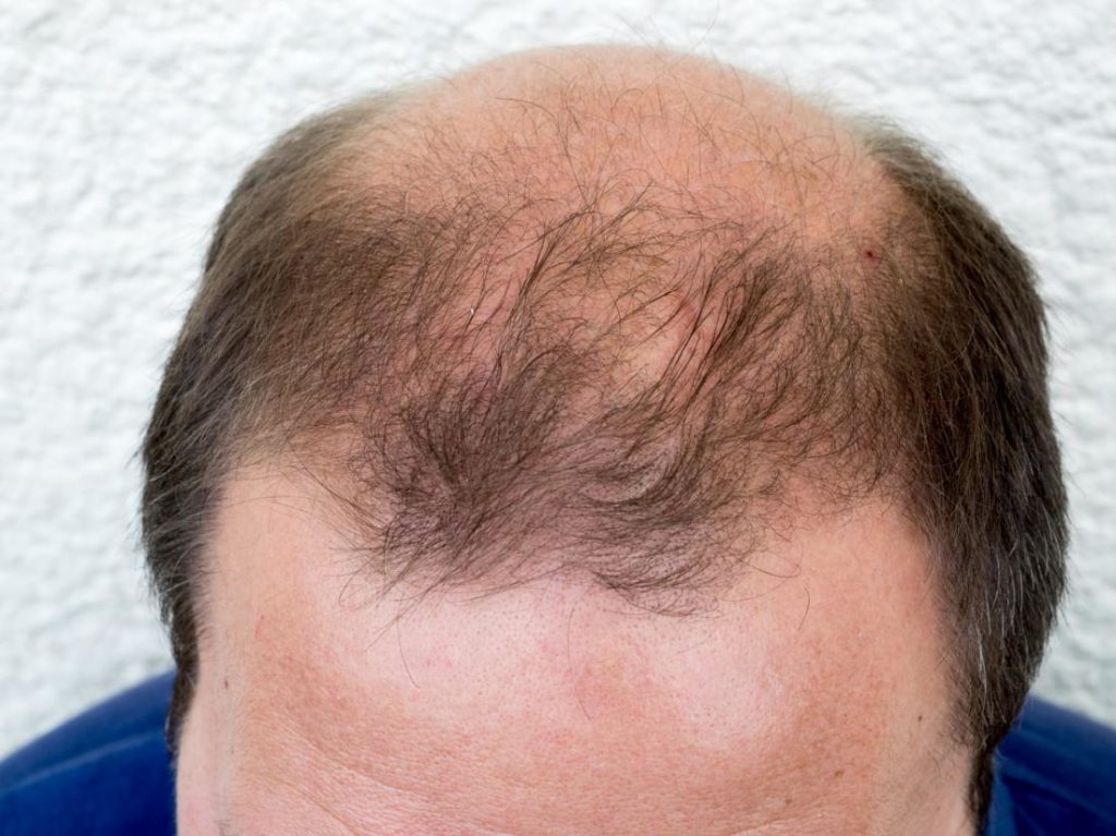 DHT (dihydrotestosterone) - Male pattern baldness